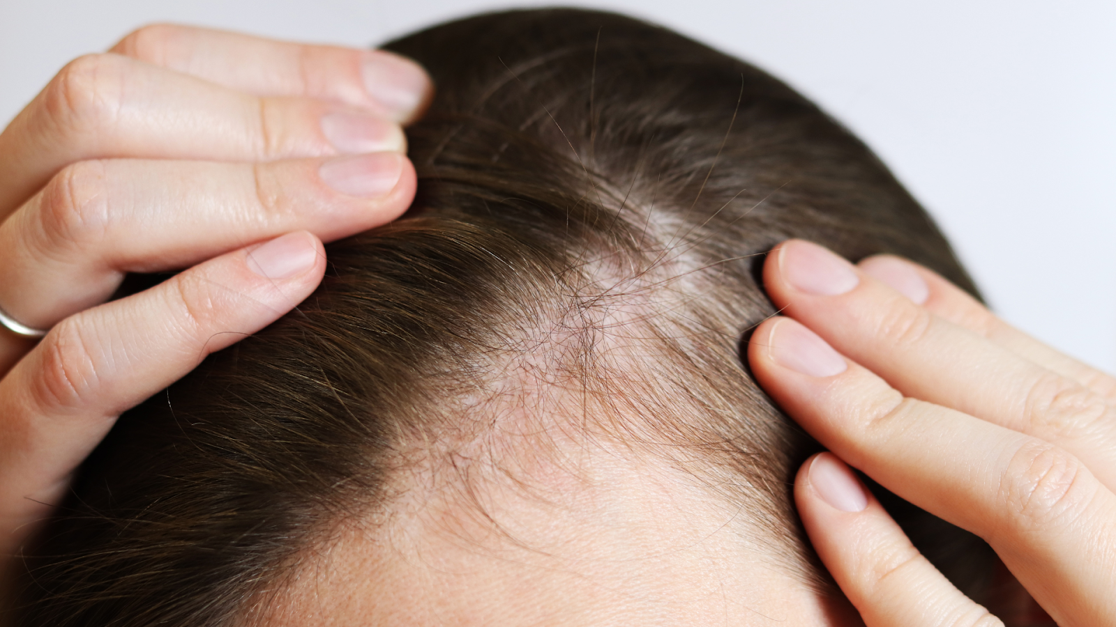 Woman’s scalp showing visible thinning hair, common in postpartum hair loss